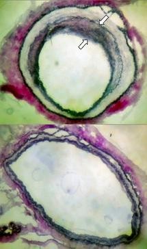 The rejection response (top, arrows) to a transplanted blood vessel in a mouse i