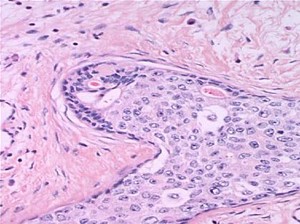 Breast cancer tissue.