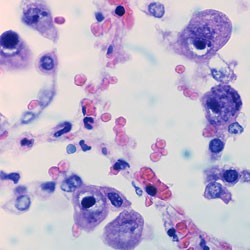 Cytomegalovirus infection.