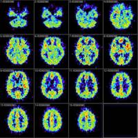 1 in 3 children who survive meningitis will suffer after-effects