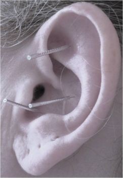 Acupuncture treatment for xerostomia