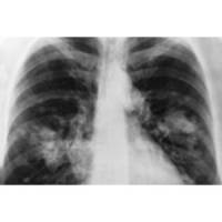 Skin rash predicts survival benefit from latest lung cancer drug