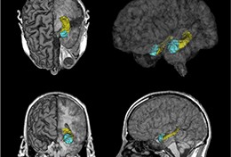 Brain pictures show the hippocampus in yellow and the amygdala in blue.