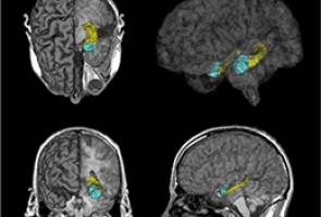 Sugar really does rot your brain: study