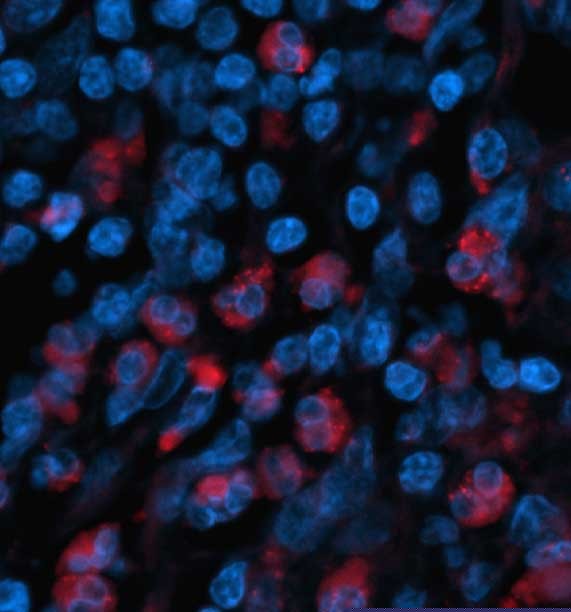 Tumor cells secrete signals that call in wound healing cells to the tumor site. 