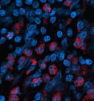 Decoded: Molecular messages that tell prostate and breast cancers to spread