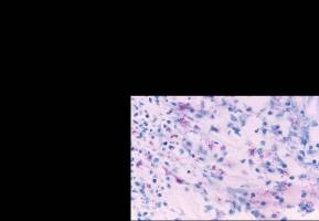 Insights into how TB tricks the immune system could help combat the disease