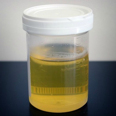 Not as simple as it seems: UAlberta research shows that human urine can contain 