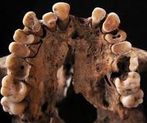Tooth decay in a young adult hunter-gatherer from Taforalt (Image: Isabelle de G