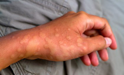 Severe skin rash is a symptom of a family of rare autoinflammatory diseases that