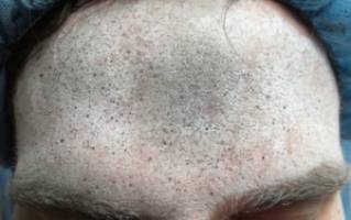 Novel Use of 3-D Imaging Technique for Precise Measurement of Injectable Wrinkle Reducers