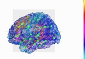 A virtual brain helps decrypt epilepsy