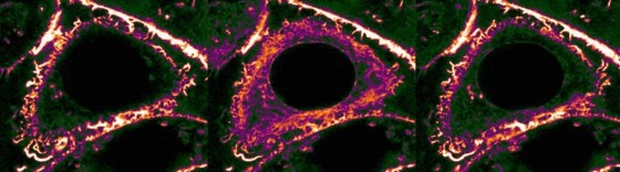 CaAR in a breast cancer cell after perforation of the plasma membrane with a nee