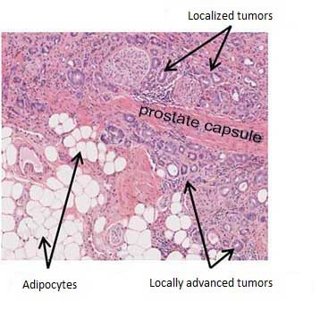 � Catherine Muller  Prostate cancer can remain localized in the prostate gland. 