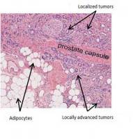 Why prostate cancer is more aggressive in obese patients