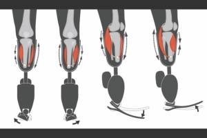 Surgical technique improves sensation, control of prosthetic limb