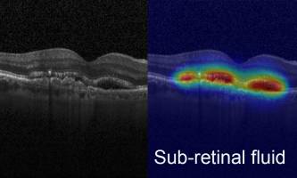 Advanced AI boosts clinical analysis of eye images