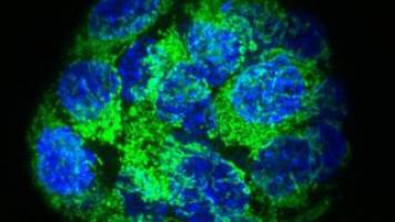 New way to eliminate cancer stem cells in prostate cancer