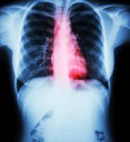 Salt rules linked to 9900 cases of cardiovascular disease and 1500 cancer cases