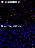 Stroke: News about platelets