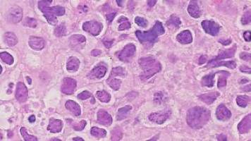IOR lays the foundation for a new clinical trial against lymphomas