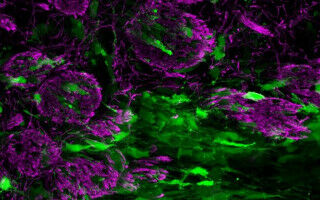Aggressive brain tumours can mimic normal brain repair processes