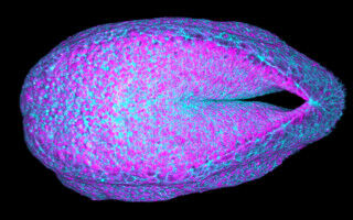 Spina bifida can be caused by uninherited genetic mutations