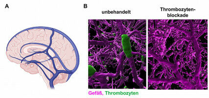 Mechanism of Cerebral Venous Thrombosis Discovered