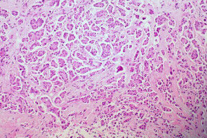 New test could detect breast and ovarian cancer from cervical screening samples