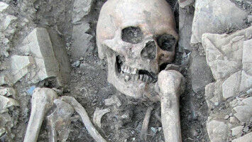 Oldest case of a rare genetic condition discovered