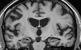 Poor heart health predicts premature brain ageing