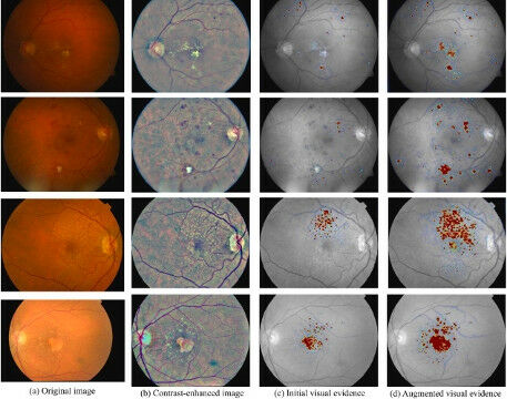 Visual evidence for AI-based grading of diabetic retinopathy (Gonz�lez-Gonzalo e