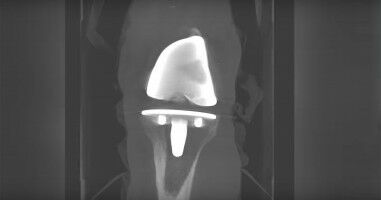 Can probiotics can improve outcomes in knee replacement surgeries?