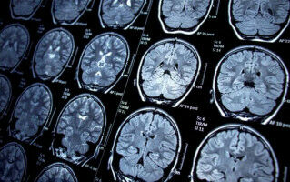 Connections in the brain involved in epileptic seizures identified