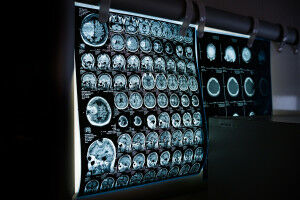 Brain: MRI scans may reveal risk of brain hemorrhage