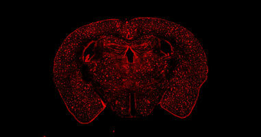Link between Alzheimer's disease and sex hormones