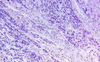 Research autopsies reveal how incurable skin cancer resists treatment