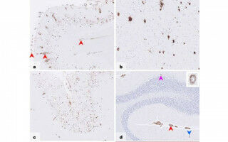 Alzheimer's disease acquired from historic medical treatments