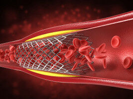 Coronary Stents: Acute inflammation triples the risk of thrombosis