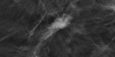 Early detection of breast cancer