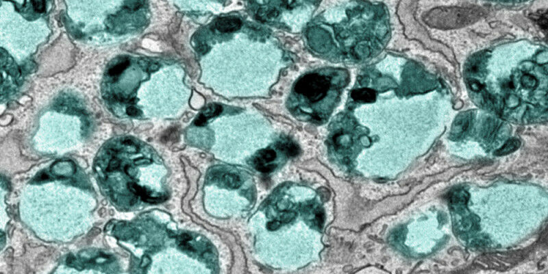 Cells of patients with LRBA-deficiency accumulate enlarged endolysosomes (green)