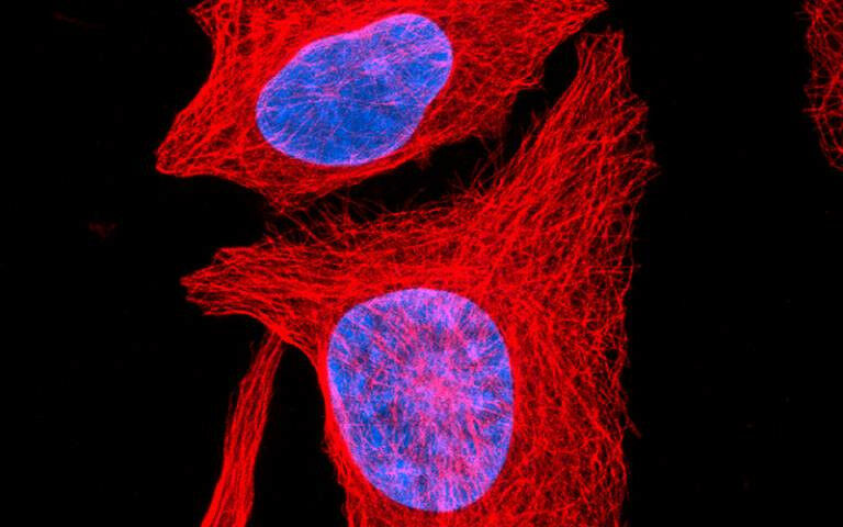 Osteosarcoma cells - Credit: Human osteosarcoma cells. Paul Appleton, University