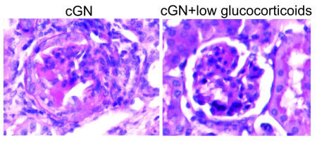 Less can be more: Low-dose steroids could effectively treat severe kidney inflammation