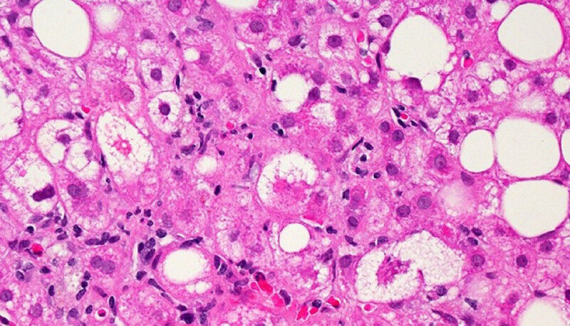 The white circles in this microscopic image are lipid droplets that accumulate i