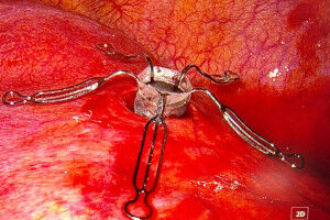 New method for treating benign pleural effusions used for the first time worldwide at MedUni Vienna/University Hospital Vienna