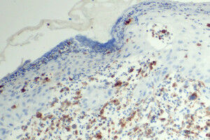 New study opens up promising therapeutic prospects for rare skin cancer