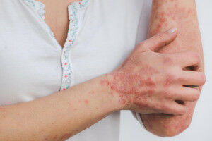New treatment option for psoriasis discovered
