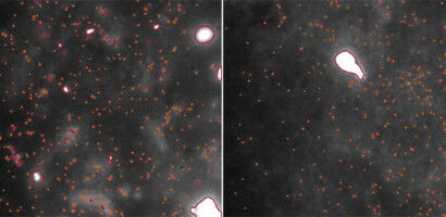 Parkinson's 'trigger' directly observed in human brain tissue for the first time
