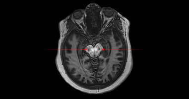 Potential biological link between cannabis and psychosis