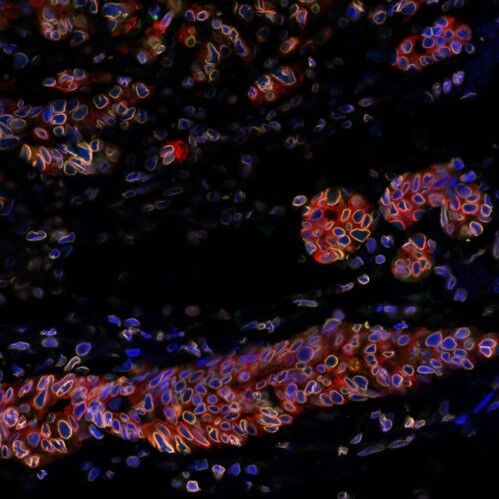 Breast tumour in an animal. The cells are labelled in blue and the keratin 8 mol